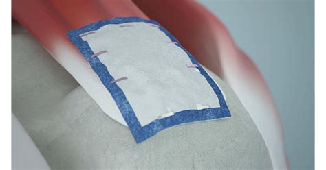 REGENETEN Bioinductive Implant .